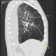 Pneumocystis carinii, pneumocystic pneumonia, HRCT: CT - Computed tomography